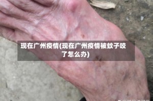现在广州疫情(现在广州疫情被蚊子咬了怎么办)